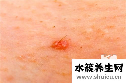 背部毛囊炎