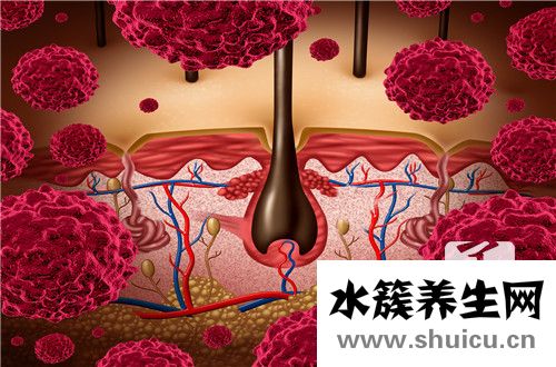 背部毛囊炎