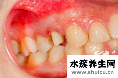 牙釉质损伤修复方法