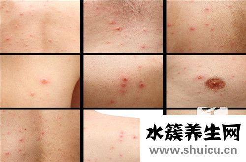 湿疹注意事项