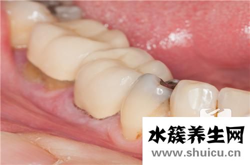 抽烟牙黄怎么办