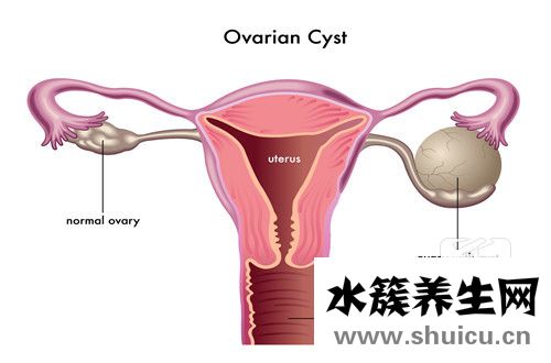 子宫肌瘤有什么症状