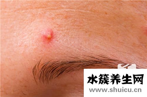 火疖子的快速治疗方