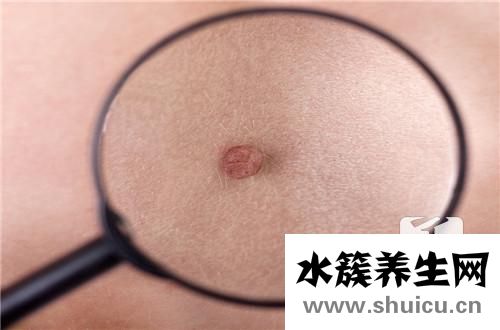 闭口和粉刺的区别