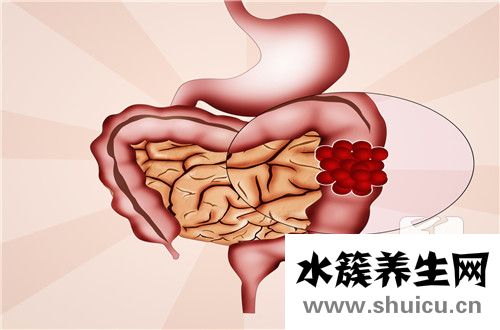 低级别上皮内瘤变