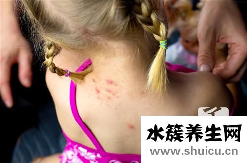 湿毒最佳治疗方法