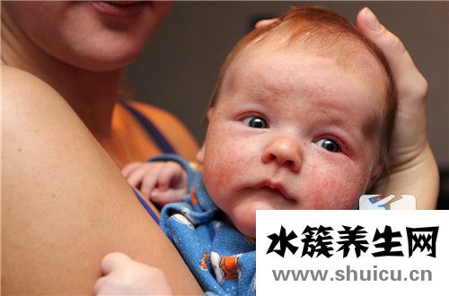 脸部湿疹