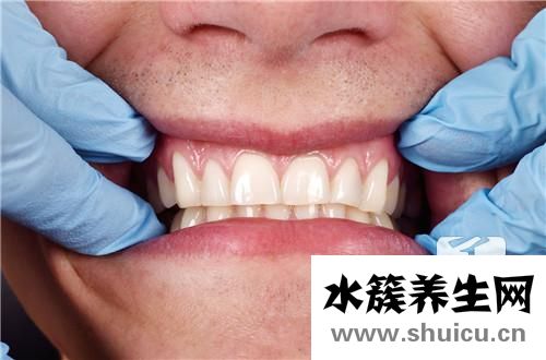 洗牙注意事项