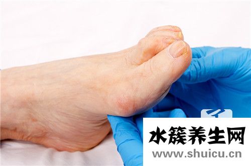 脚上长跖疣怎么治