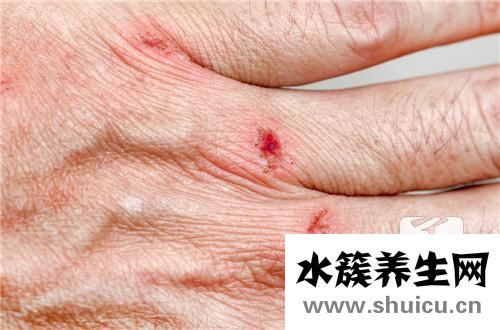 被老鼠抓伤了怎么办