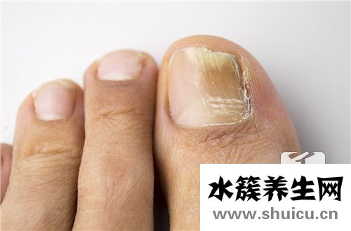 指甲往肉里长怎么办