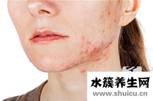 腮边长痘是什么原因