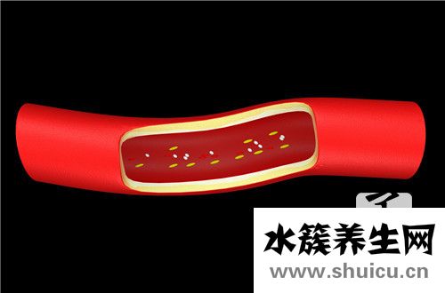 主动脉钙化