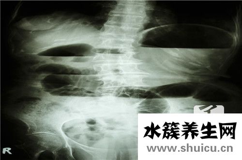 做完胃镜后注意事项