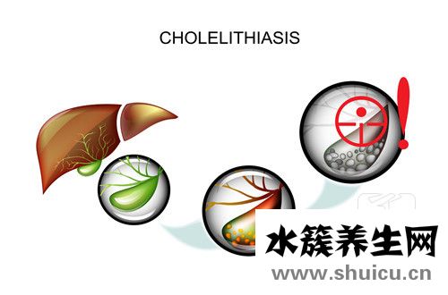 胆结石有什么症状