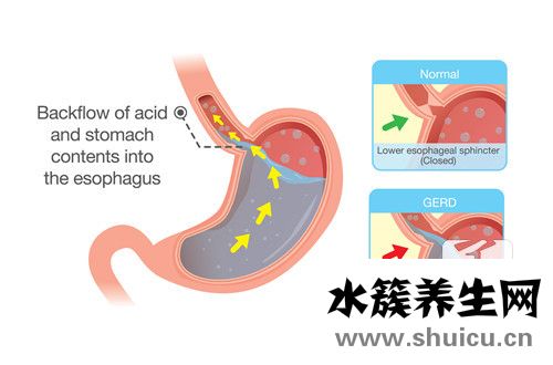 胃反酸是怎么回事