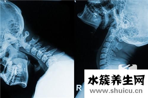 颈椎骨质增生怎么办