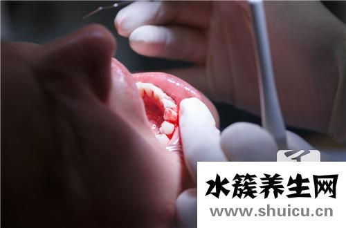 甲硝唑片治牙周炎