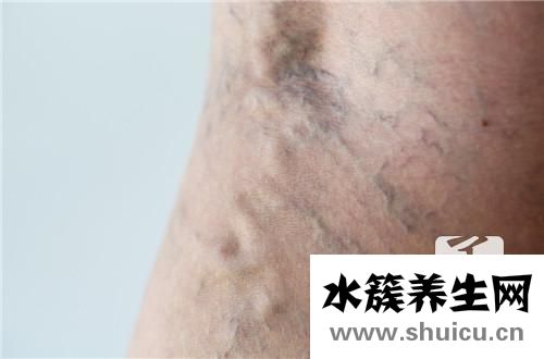 脉络丛囊肿