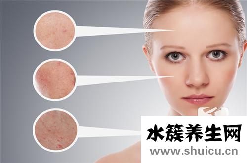结节囊肿型痤疮