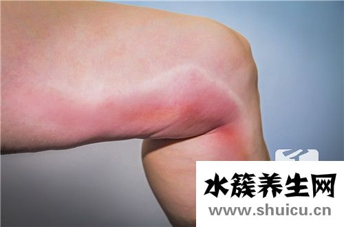 气郁血瘀的症状有哪些