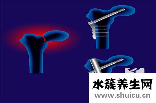 肱骨外上髁炎