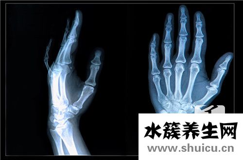 桡骨远端骨折