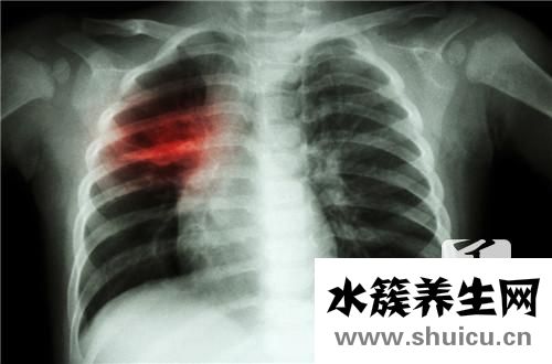 结核抗体
