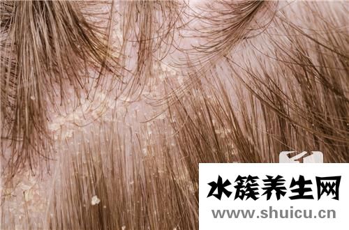 去头屑小妙招