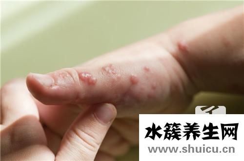 皮肤细菌感染