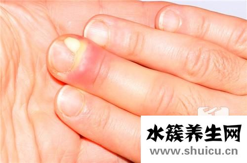下肢水肿