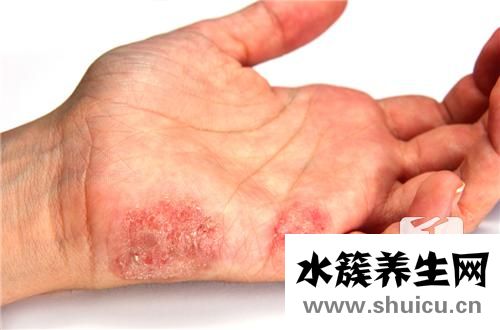 水泡型手癣用什么药膏