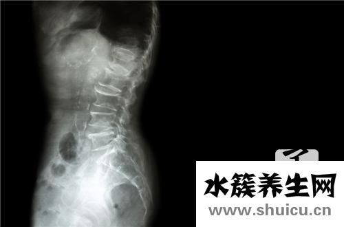 跟骨骨刺