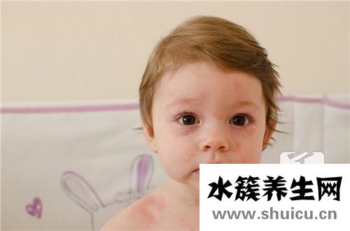小儿热疹