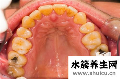 补牙痛吗