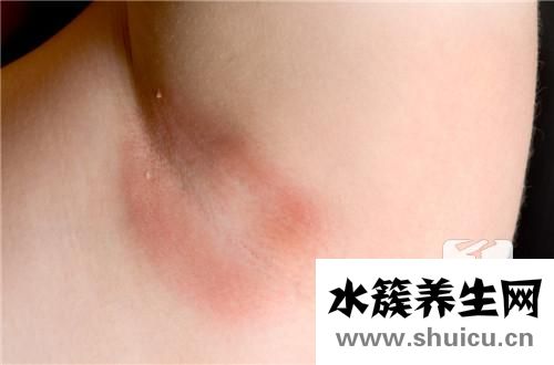 荨麻疹是否会传染