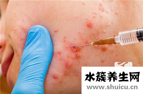 脸上的痘坑怎么治