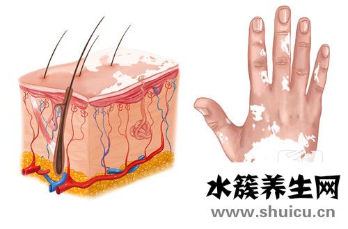白殿疯病