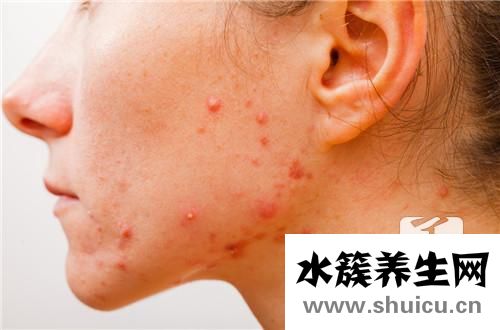 青春痘多久才会好