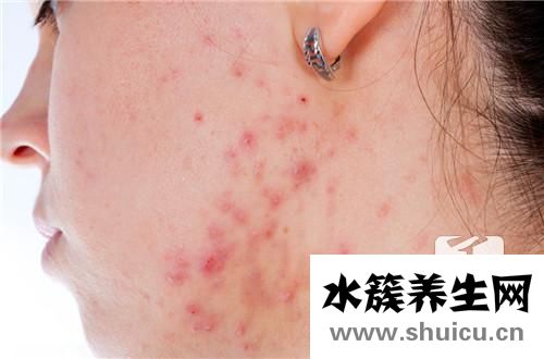 右脸颊反复长痘的原因？