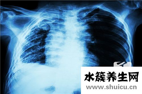 肺部纤维灶