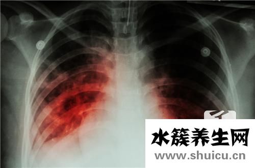 肺结核皮试结果怎么看