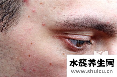 男生去痘痘