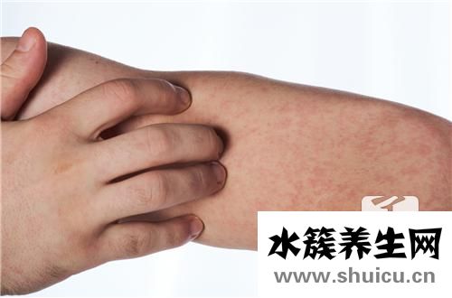 静脉炎的护理