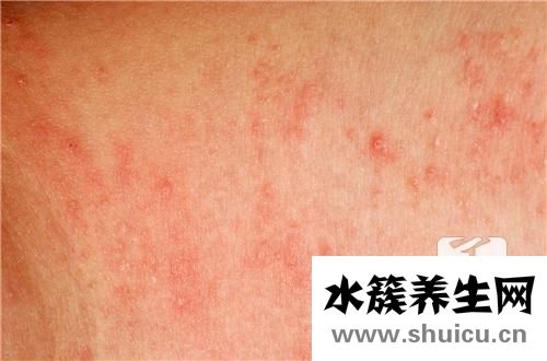 疥疮怎么引起的