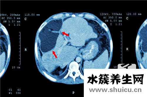 乙肝表面抗原弱阳性