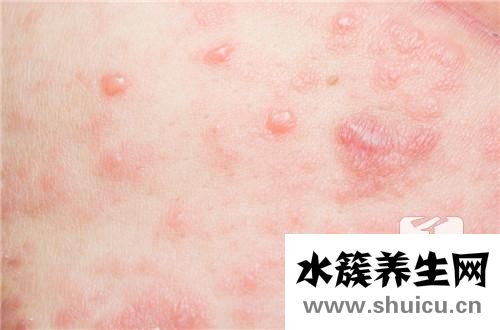 中医治疗寻麻疹