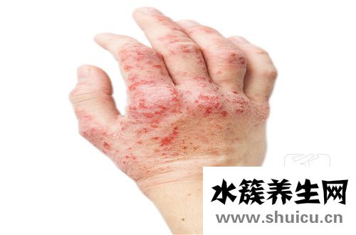 中医治疗寻麻疹