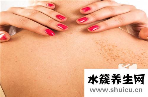 黑痣发痒