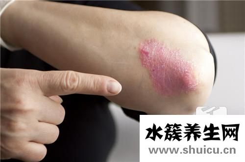 湿毒症状